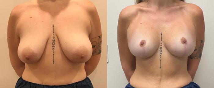 Before & After Breast Augmentation with Mastopexy (Lift) Case 375 Front View in Barrington, Illinois