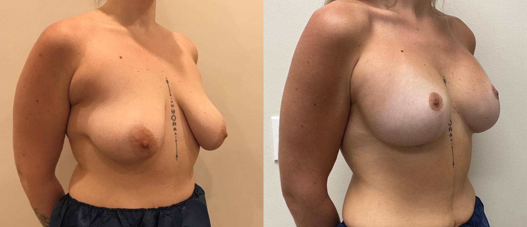 Before & After Breast Augmentation with Mastopexy (Lift) Case 375 Right Oblique View in Barrington, Illinois