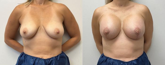 Before & After Breast Augmentation with Mastopexy (Lift) Case 376 Front View in Barrington, Illinois