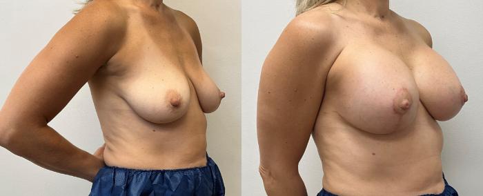 Before & After Breast Augmentation with Mastopexy (Lift) Case 376 Right Oblique View in Barrington, Illinois