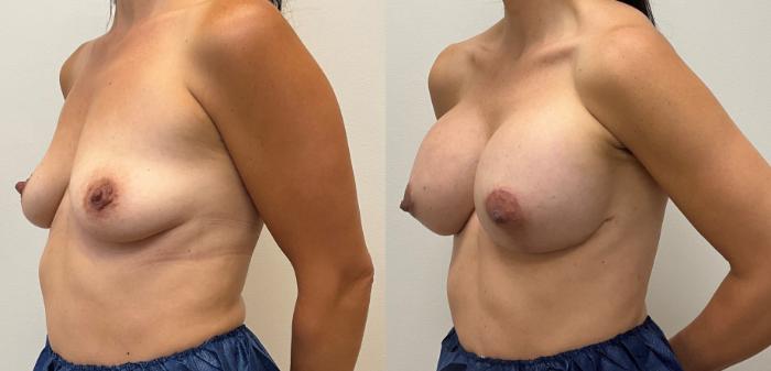 Before & After Breast Augmentation with Mastopexy (Lift) Case 383 Left Oblique View in Barrington, Illinois