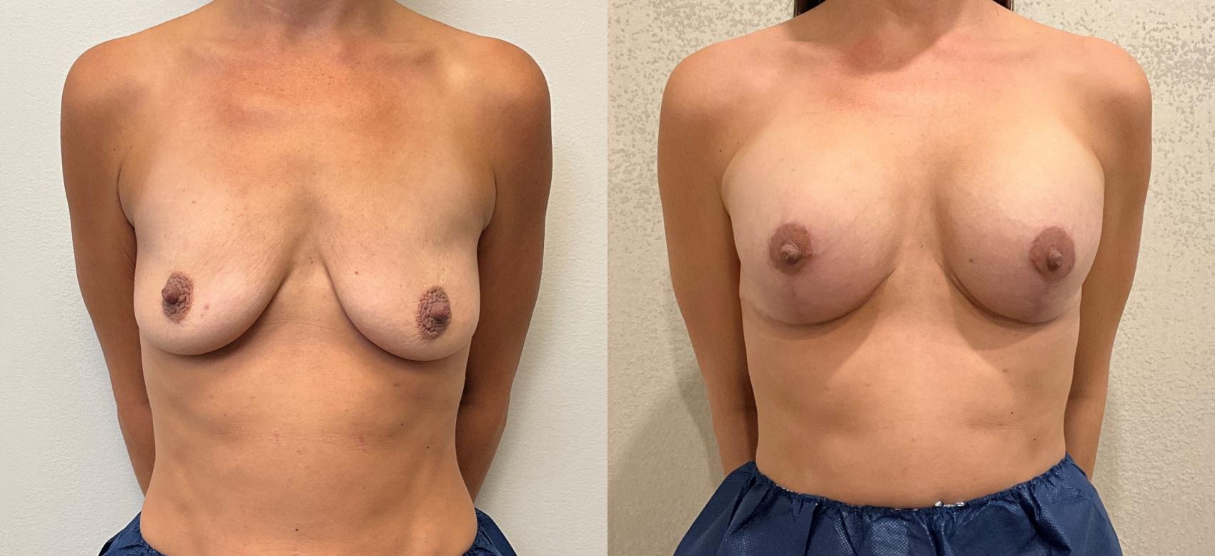 Before & After Breast Augmentation with Mastopexy (Lift) Case 387 Front View in Barrington, Illinois