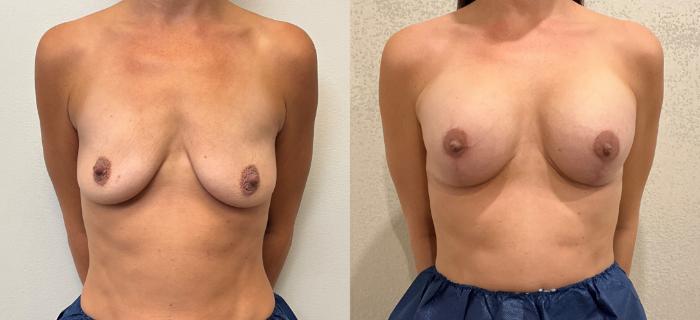 Before & After Breast Augmentation with Mastopexy (Lift) Case 387 Front View in Barrington, Illinois