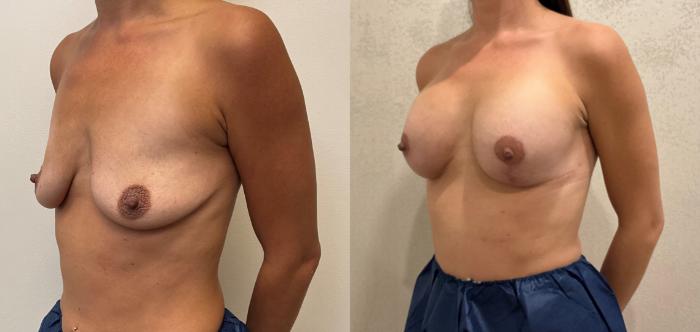 Before & After Breast Augmentation with Mastopexy (Lift) Case 387 Left Oblique View in Barrington, Illinois