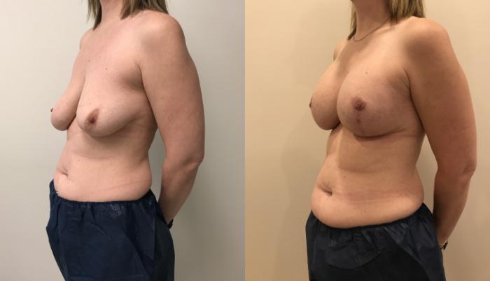 Before & After Breast Augmentation with Mastopexy (Lift) Case 404 Left Side View in Barrington, Illinois
