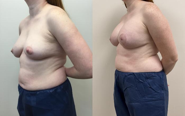 Before & After Breast Augmentation with Mastopexy (Lift) Case 405 Left Side View in Barrington, Illinois