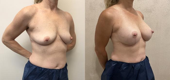 Before & After Breast Augmentation with Mastopexy (Lift) Case 406 Right Side View in Barrington, Illinois