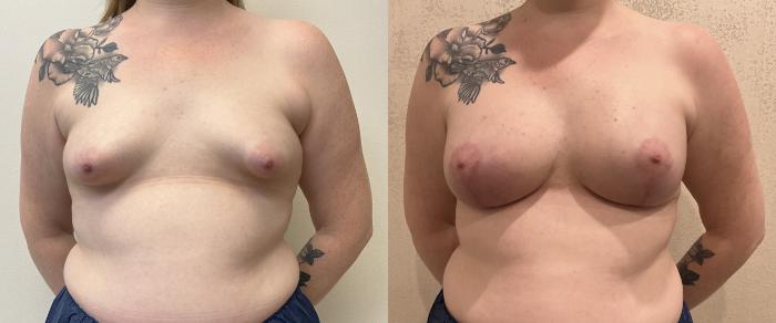 Before & After Breast Augmentation with Mastopexy (Lift) Case 417 Front View in Barrington, Illinois