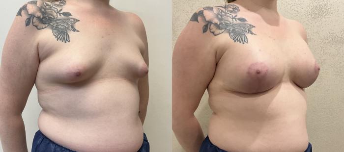 Before & After Breast Augmentation with Mastopexy (Lift) Case 417 Right Side View in Barrington, Illinois
