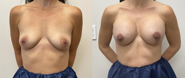 Before & After Breast Augmentation with Mastopexy (Lift) Case 421 Front View in Barrington, Illinois