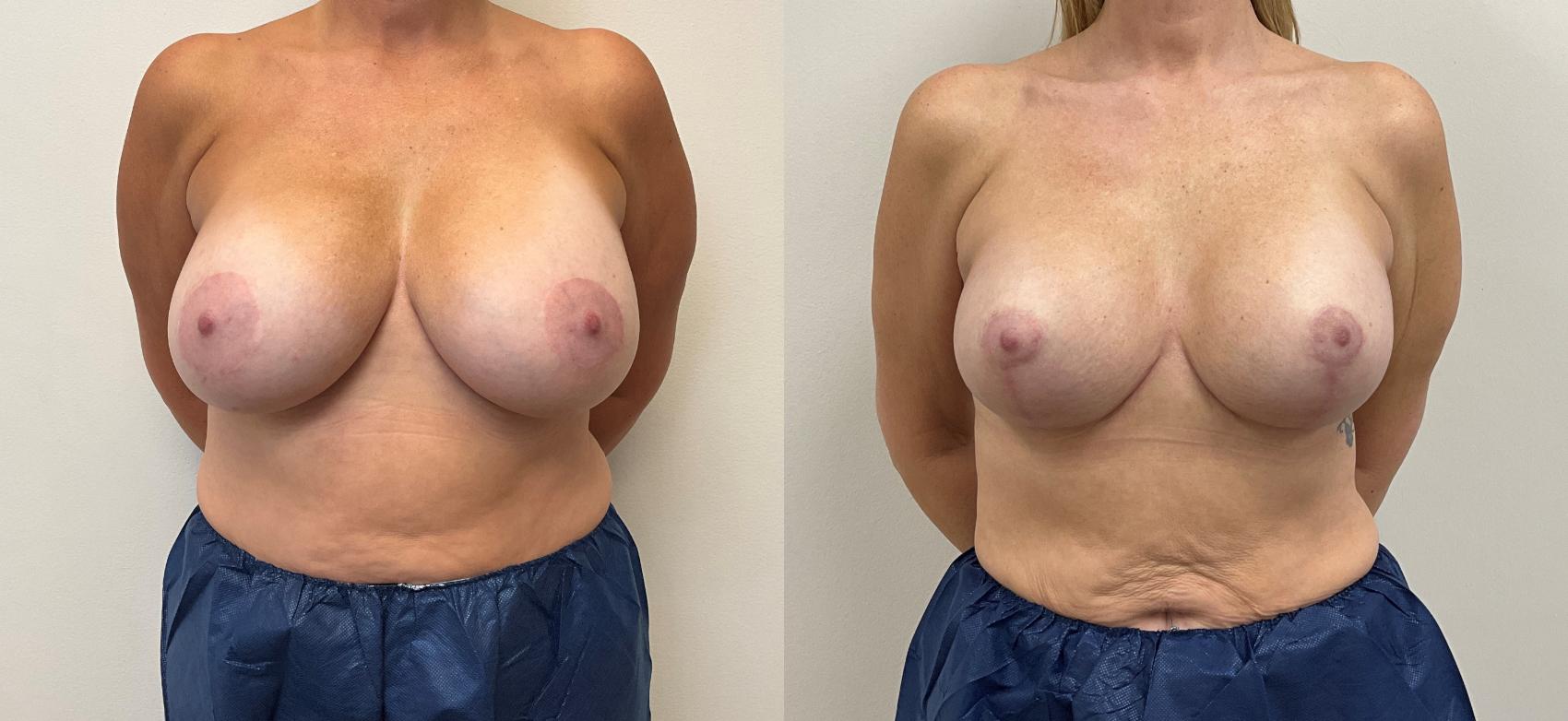 Before & After Breast Augmentation with Mastopexy (Lift) Case 428 Front View in Barrington, Illinois