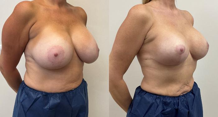 Before & After Breast Augmentation with Mastopexy (Lift) Case 428 Left Oblique View in Barrington, Illinois
