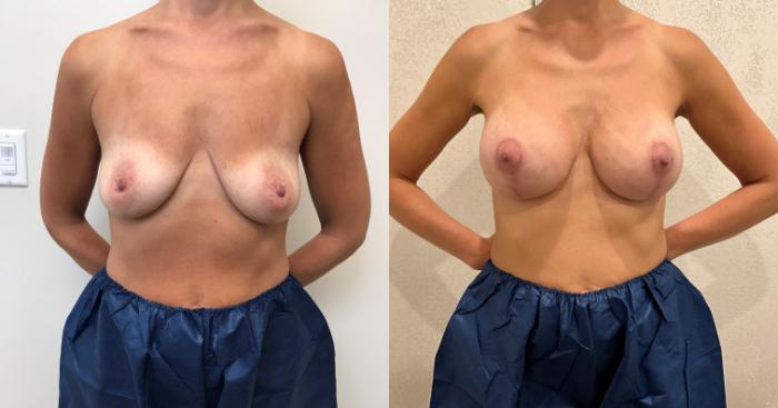 Before & After Breast Augmentation with Mastopexy (Lift) Case 440 Front View in Barrington, Illinois