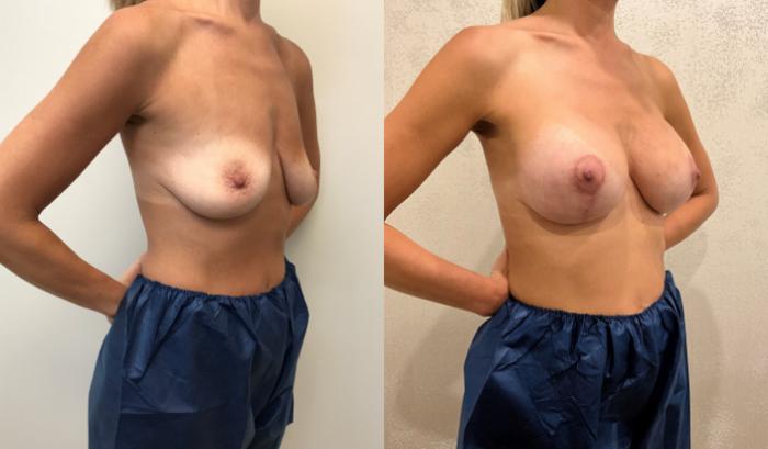 Before & After Breast Augmentation with Mastopexy (Lift) Case 440 Right Oblique View in Barrington, Illinois