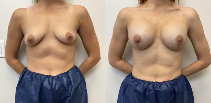 Before & After Breast Augmentation with Mastopexy (Lift) Case 441 Front View in Barrington, Illinois