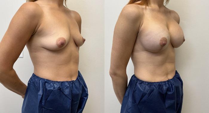 Before & After Breast Augmentation with Mastopexy (Lift) Case 441 Right Oblique View in Barrington, Illinois