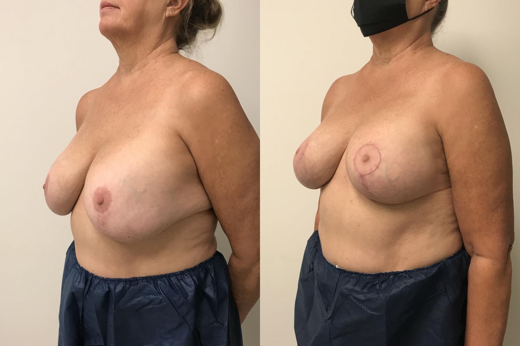 Before & After Breast Lift Case 154 Left Oblique View in Barrington, Illinois