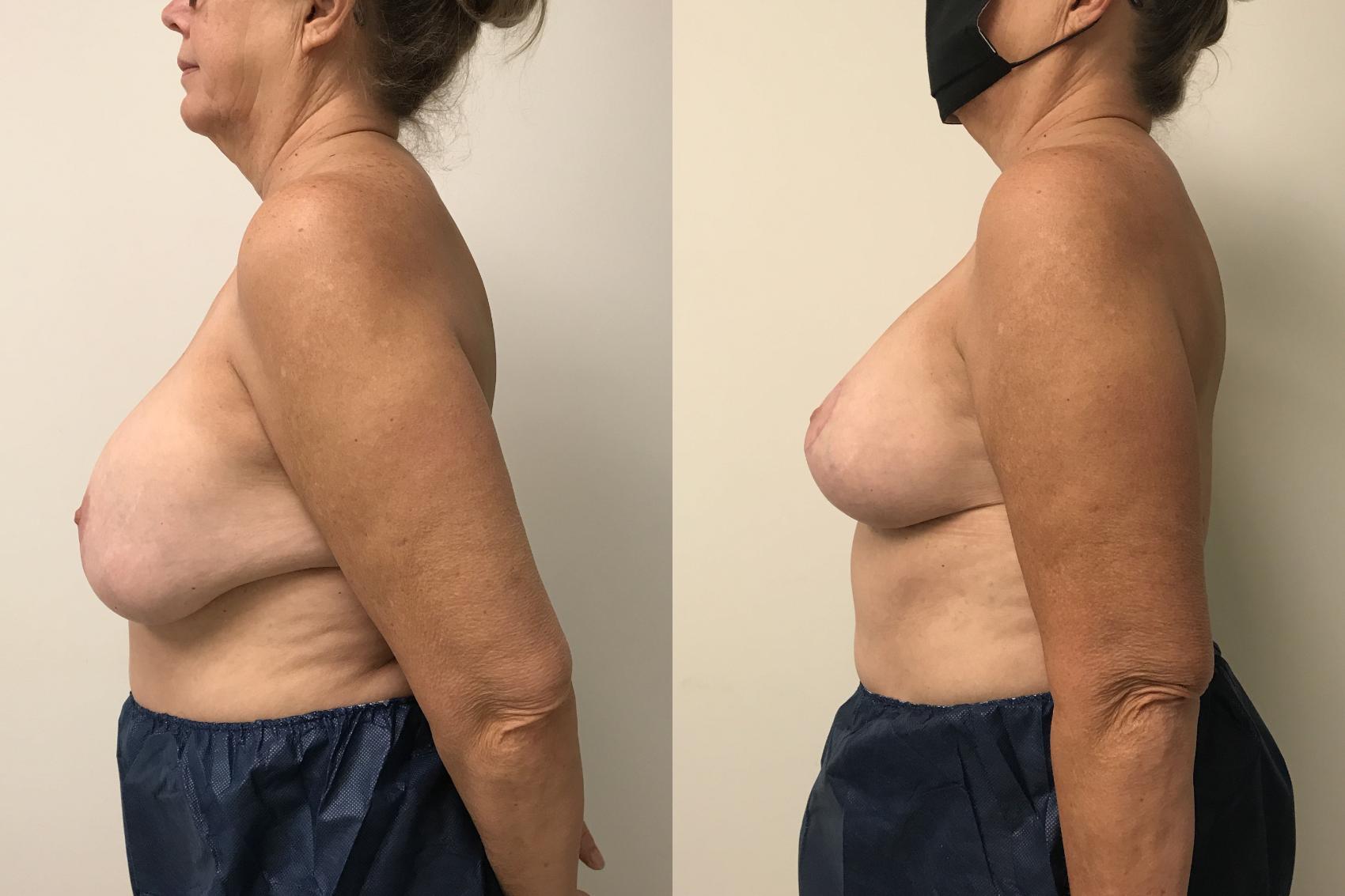 Before & After Breast Lift Case 154 Left Side View in Barrington, Illinois