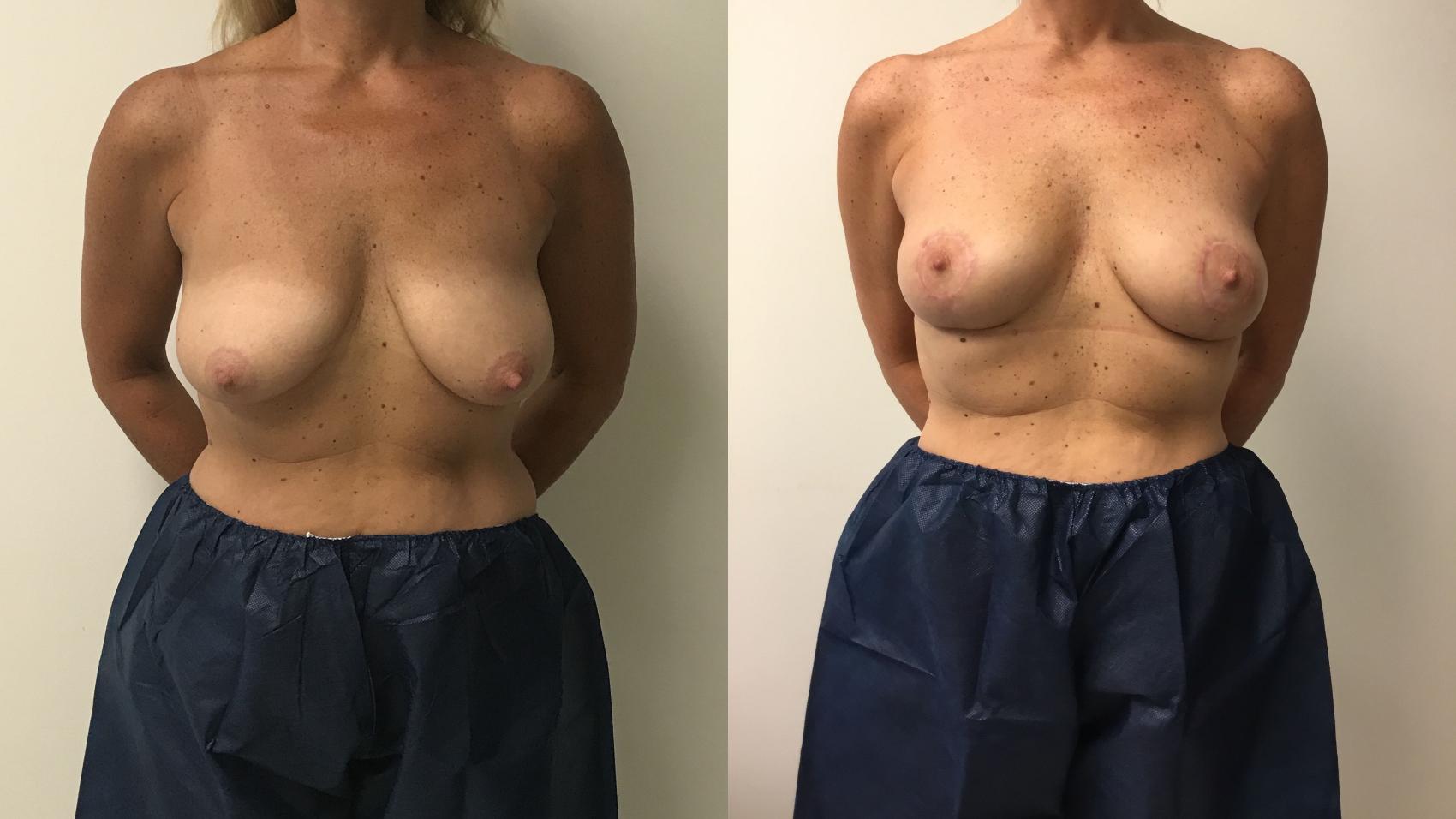 Before & After Breast Lift Case 171 Front View in Barrington, Illinois