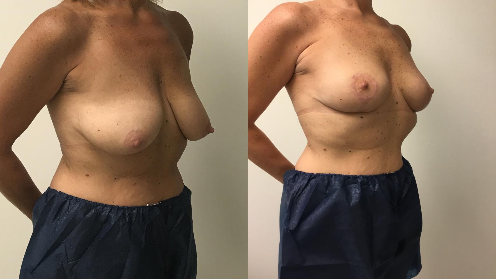 Before & After Breast Lift Case 171 Right Oblique View in Barrington, Illinois