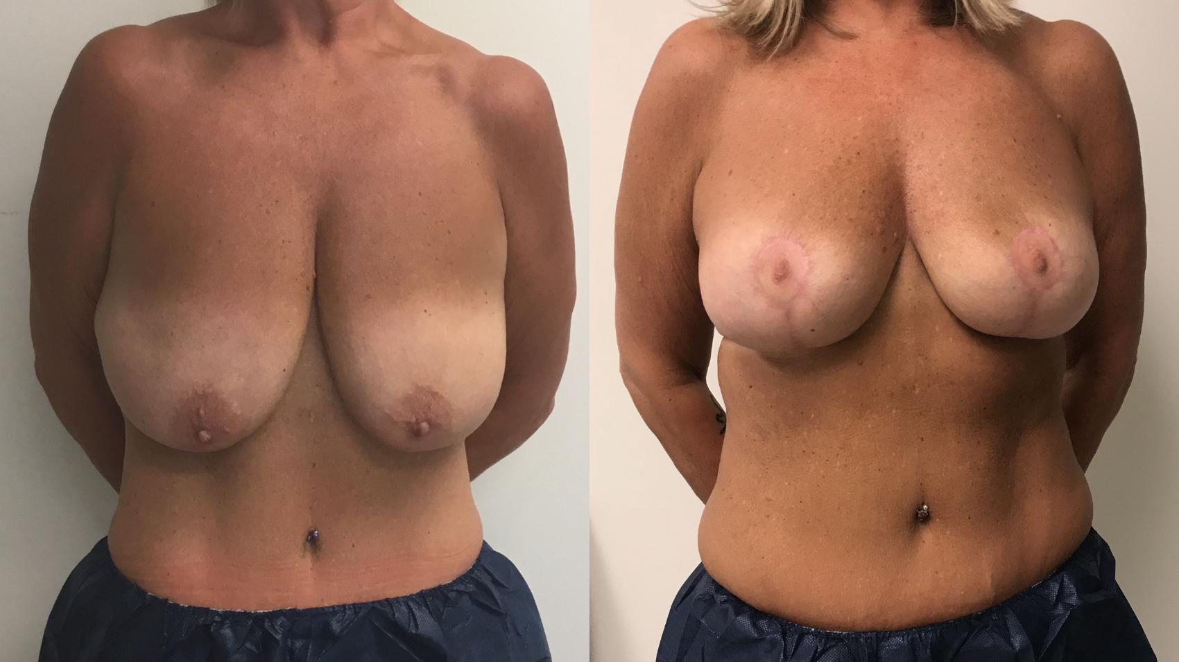 Before & After Breast Lift Case 182 Front View in Barrington, Illinois
