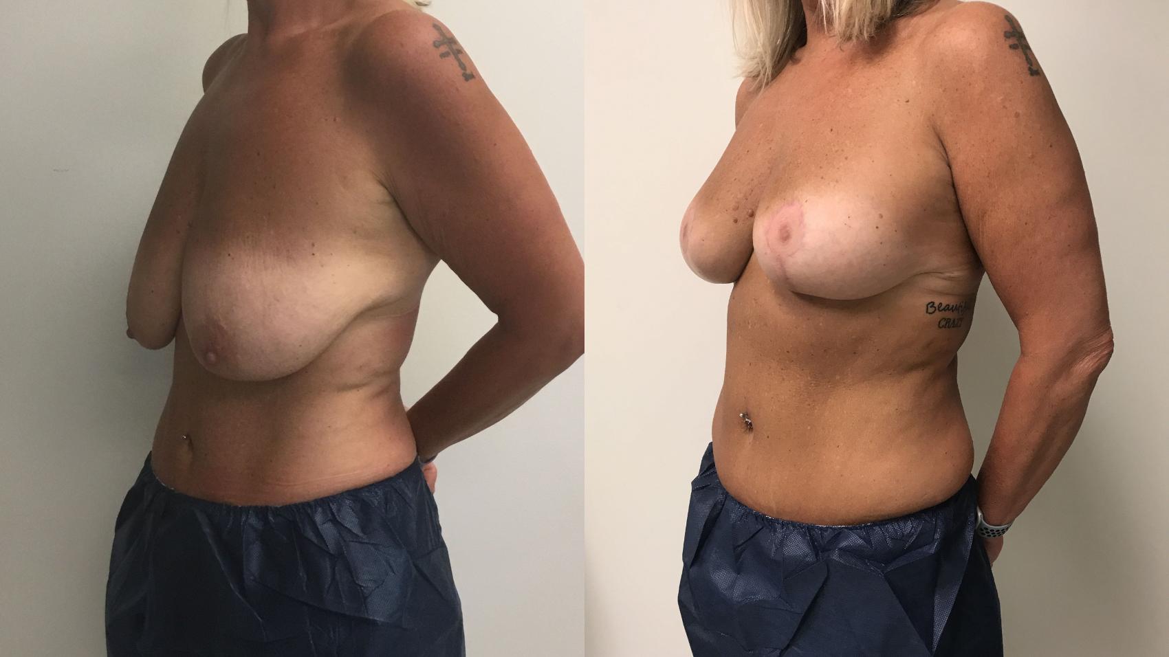 Before & After Breast Lift Case 182 Left Oblique View in Barrington, Illinois