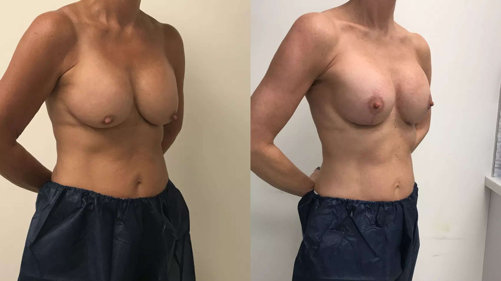 Breast Lift Before and After Pictures Case 207 | Barrington, Illinois |  Renee Burke, MD
