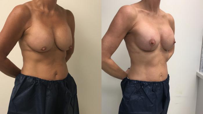 Before & After Breast Lift Case 207 Right Oblique View in Barrington, Illinois