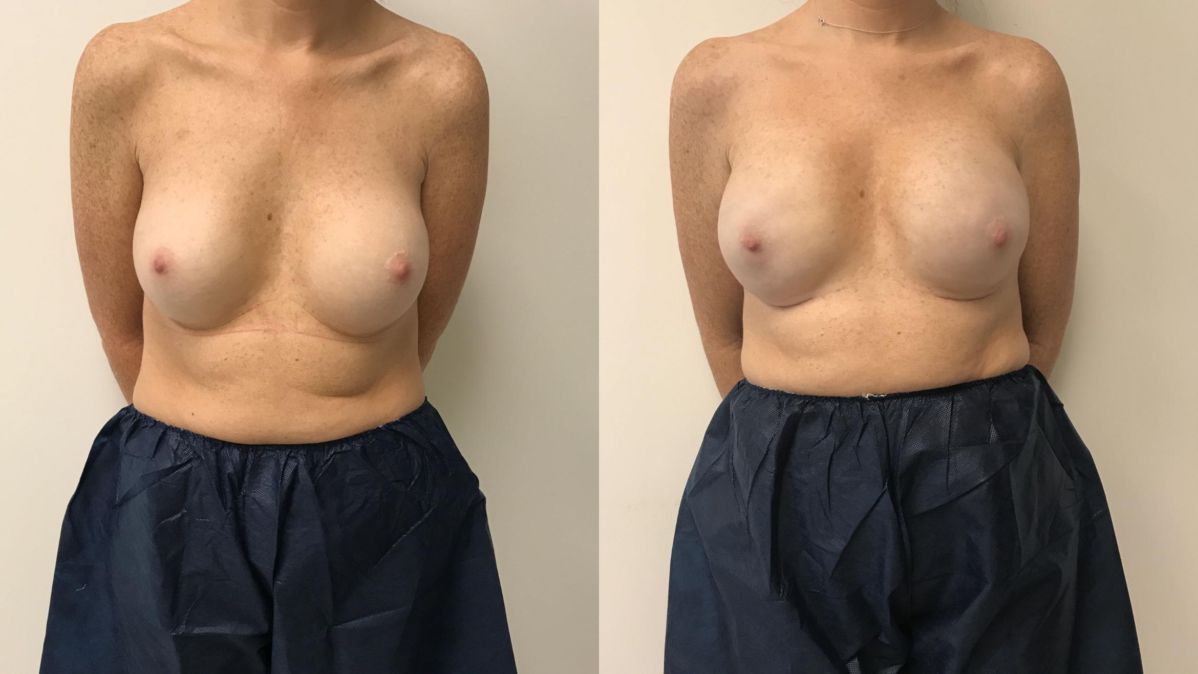 Before & After Breast Reconstruction Case 140 Front View in Barrington, Illinois