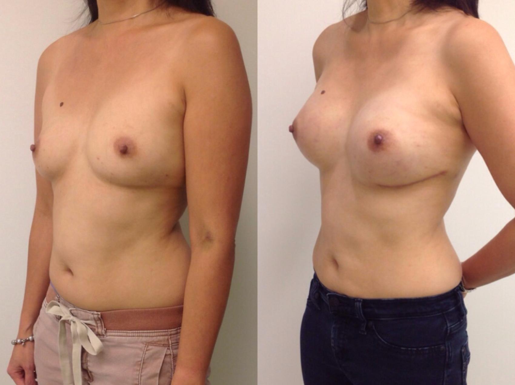 Before & After Breast Reconstruction Case 188 Left Oblique View in Barrington, Illinois