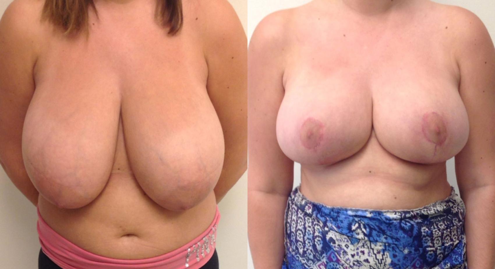Before & After Breast Reduction Case 12 View #1 View in Barrington, Illinois