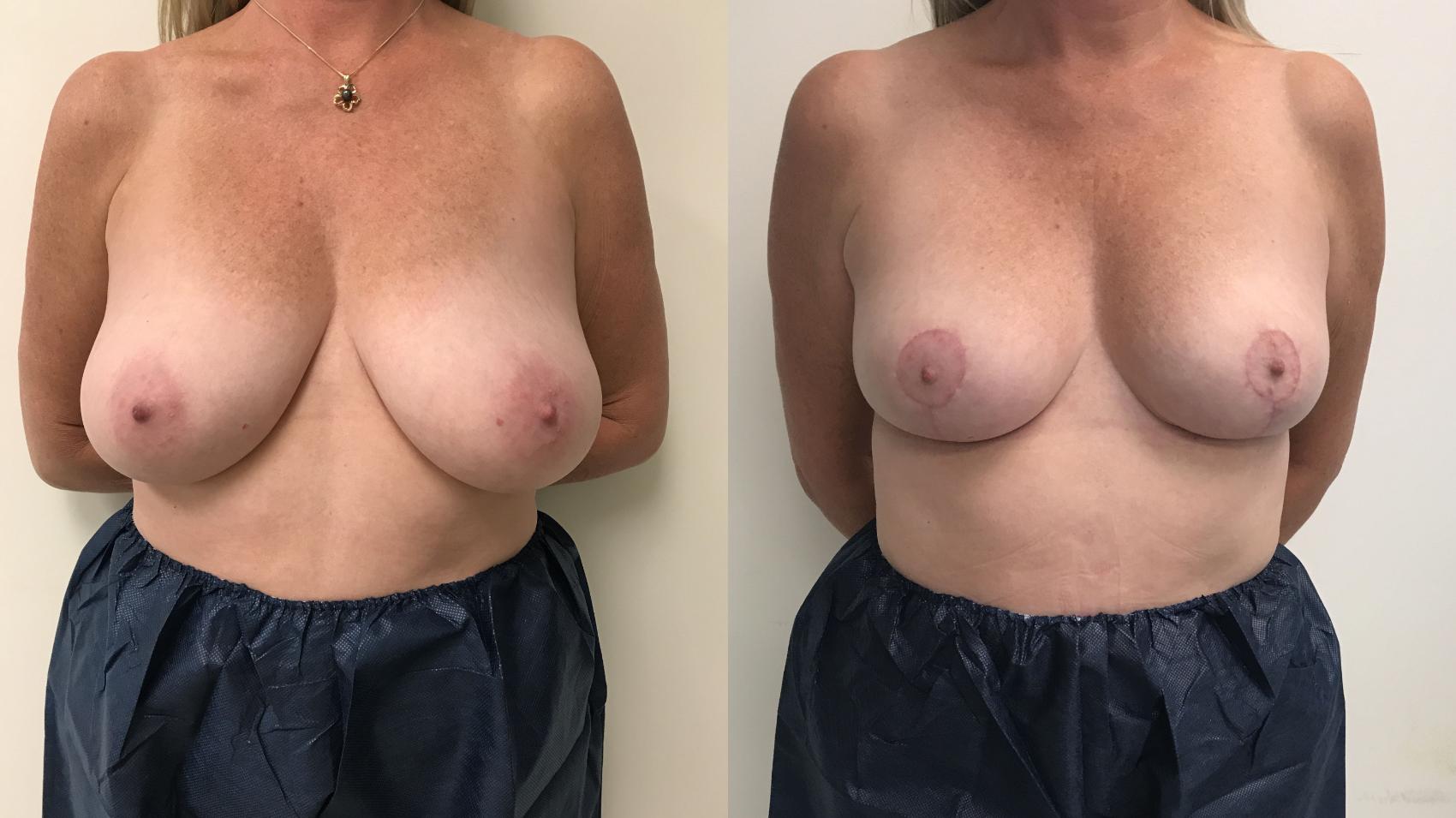 Before & After Breast Reduction Case 158 Front View in Barrington, Illinois