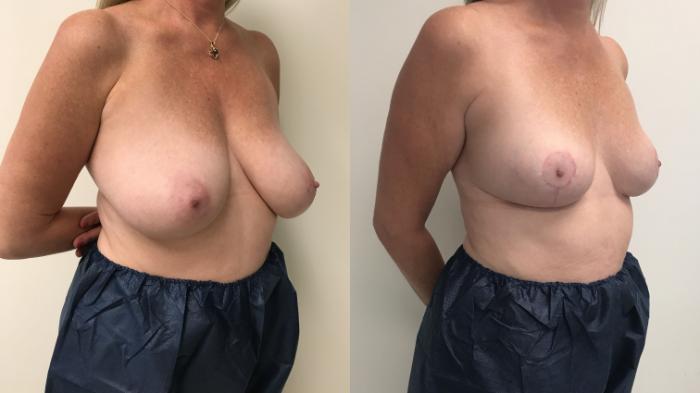 Before & After Breast Reduction Case 158 Right Oblique View in Barrington, Illinois