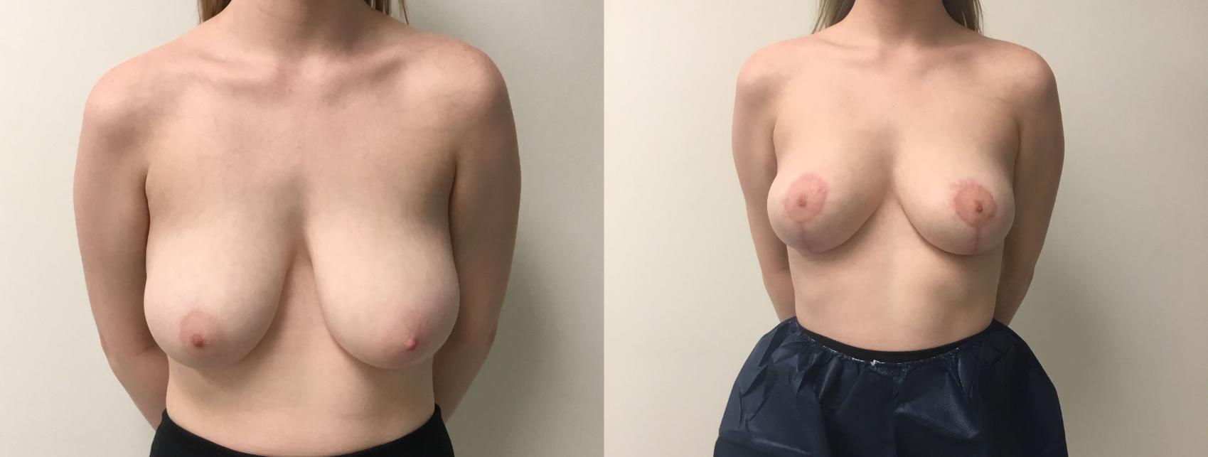 Before & After Breast Reduction Case 183 Front View in Barrington, Illinois