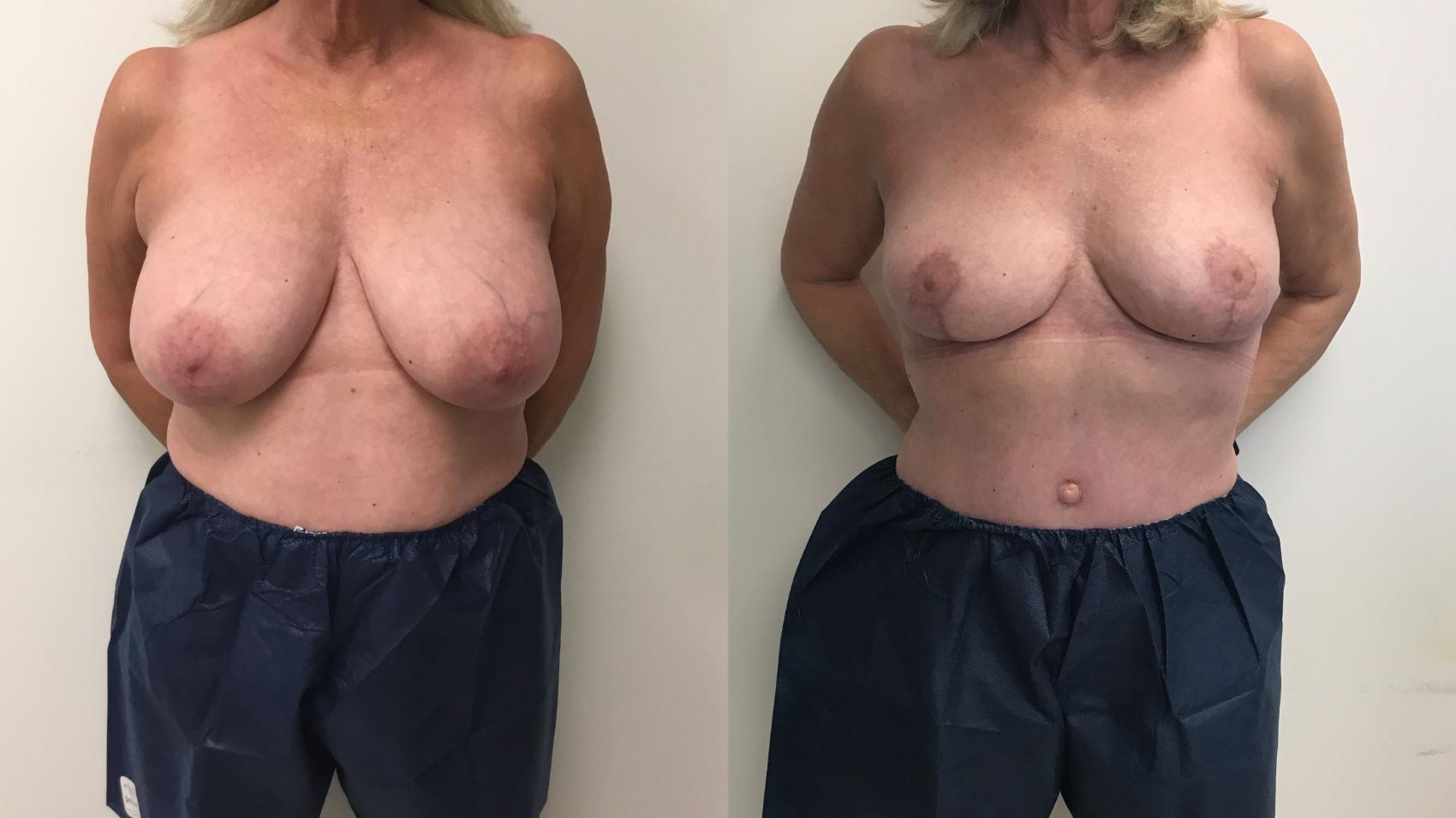 Before & After Breast Reduction Case 211 Front View in Barrington, Illinois
