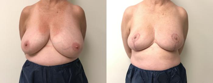 Before & After Breast Reduction Case 217 Front View in Barrington, Illinois