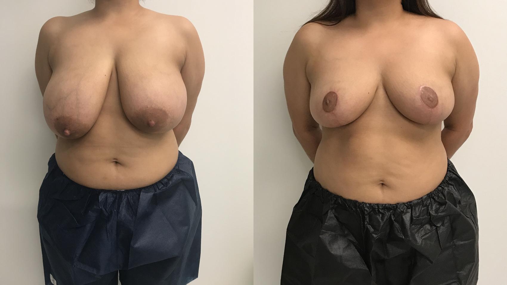 Before & After Breast Reduction Case 238 Front View in Barrington, Illinois