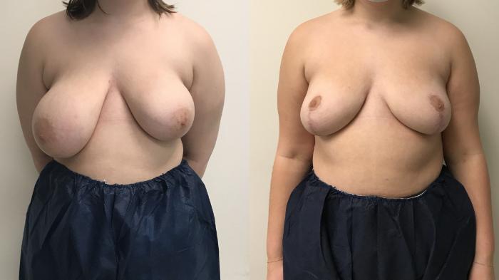 Before & After Breast Reduction Case 277 Front View in Barrington, Illinois