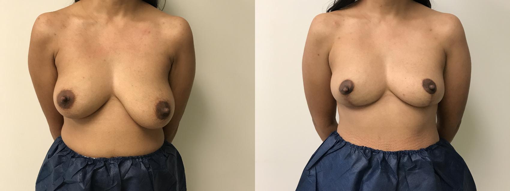 Before & After Breast Reduction Case 316 Front View in Barrington, Illinois