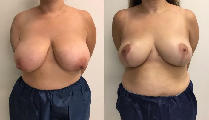 Before & After Breast Reduction Case 336 Front View in Barrington, Illinois