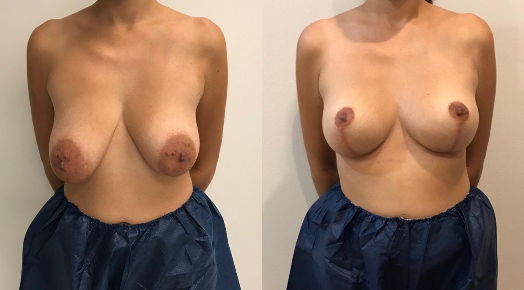Before & After Breast Reduction Case 337 Front View in Barrington, Illinois