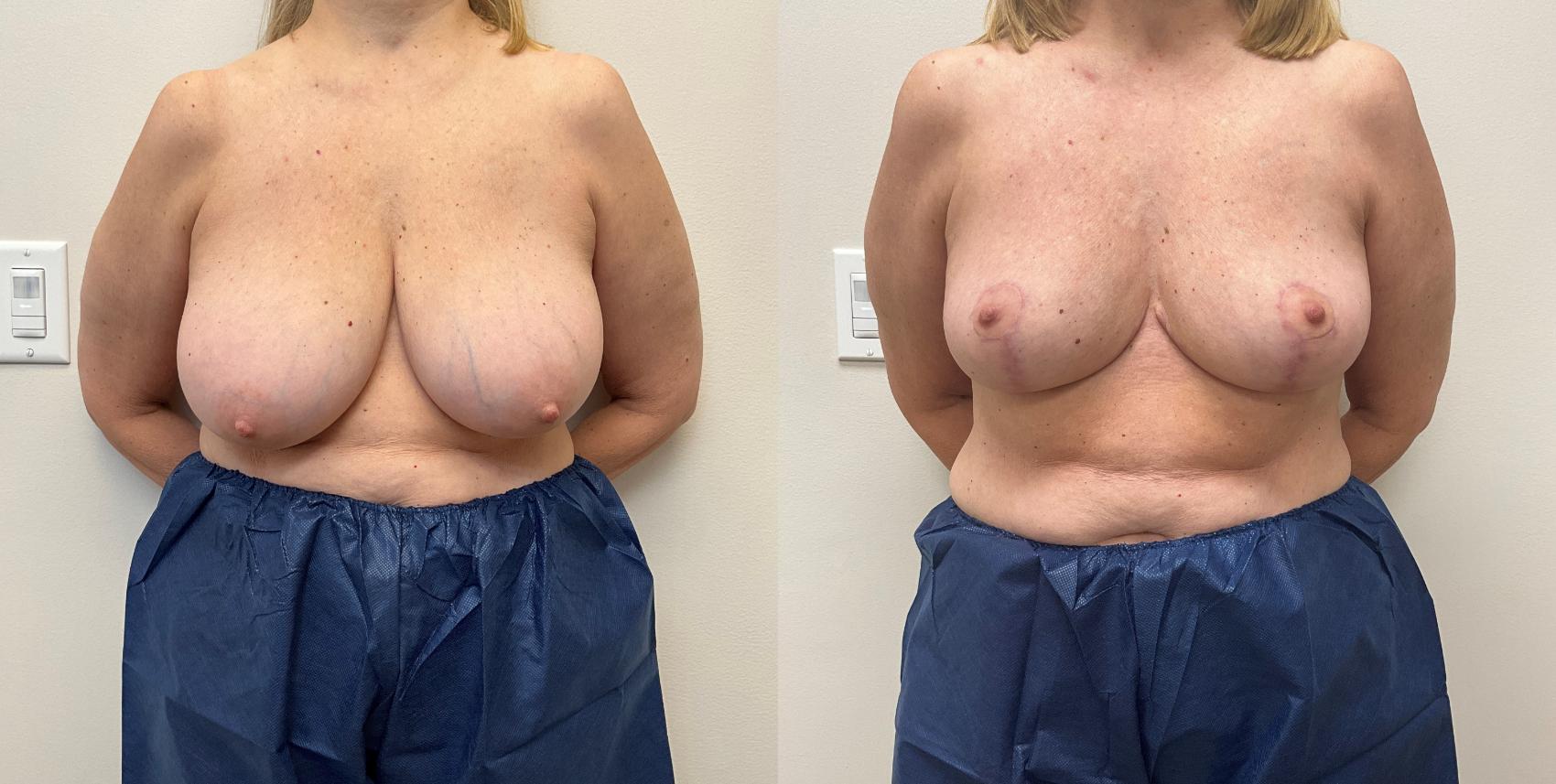 Before & After Breast Reduction Case 356 Front View in Barrington, Illinois