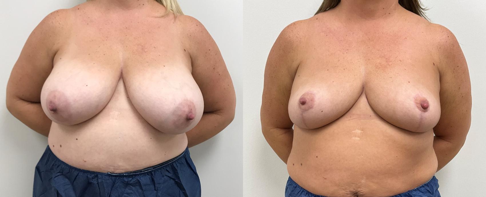 Before & After Breast Reduction Case 362 Front View in Barrington, Illinois