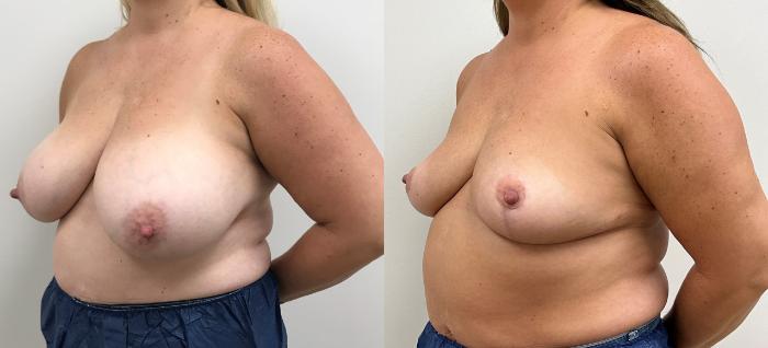 Before & After Breast Reduction Case 362 Left Oblique View in Barrington, Illinois