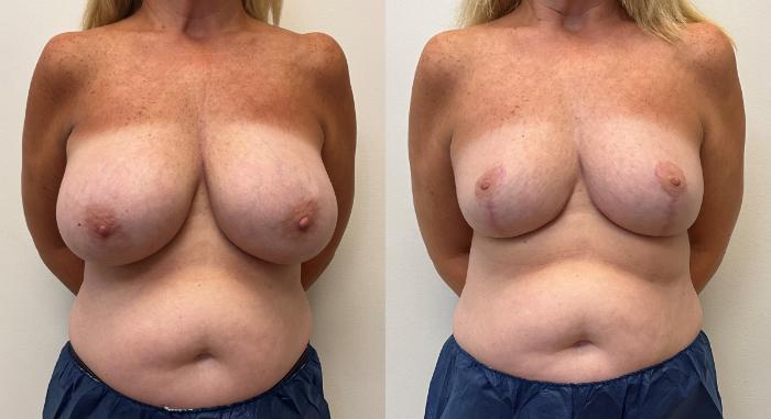 Before & After Breast Reduction Case 364 Left Oblique View in Barrington, Illinois