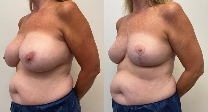 Before & After Breast Reduction Case 364 Left Side View in Barrington, Illinois