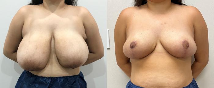 Before & After Breast Reduction Case 365 Right Oblique View in Barrington, Illinois