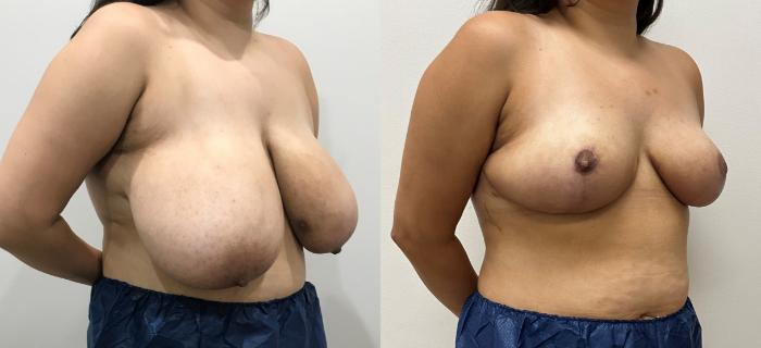 Before & After Breast Reduction Case 365 Right Side View in Barrington, Illinois