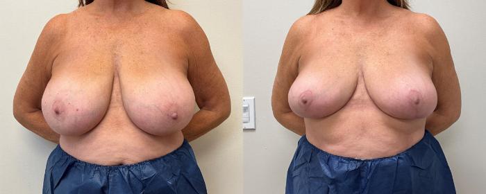 Before & After Breast Reduction Case 394 Front View in Barrington, Illinois