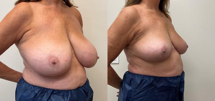 Before & After Breast Reduction Case 394 Right Oblique View in Barrington, Illinois